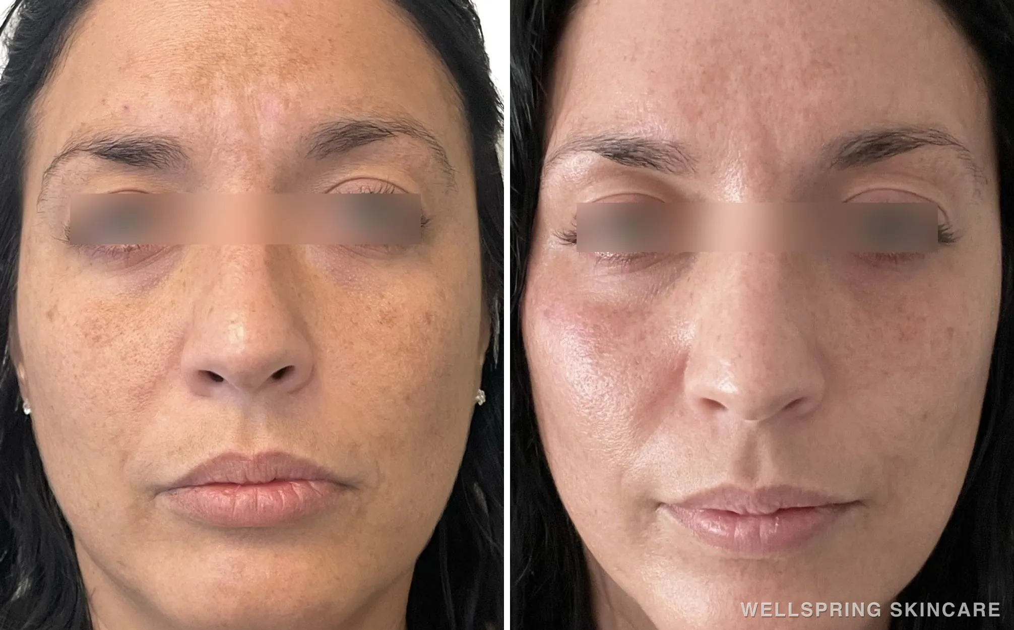 Before and after: Sun damage & brown spots treated with Halo