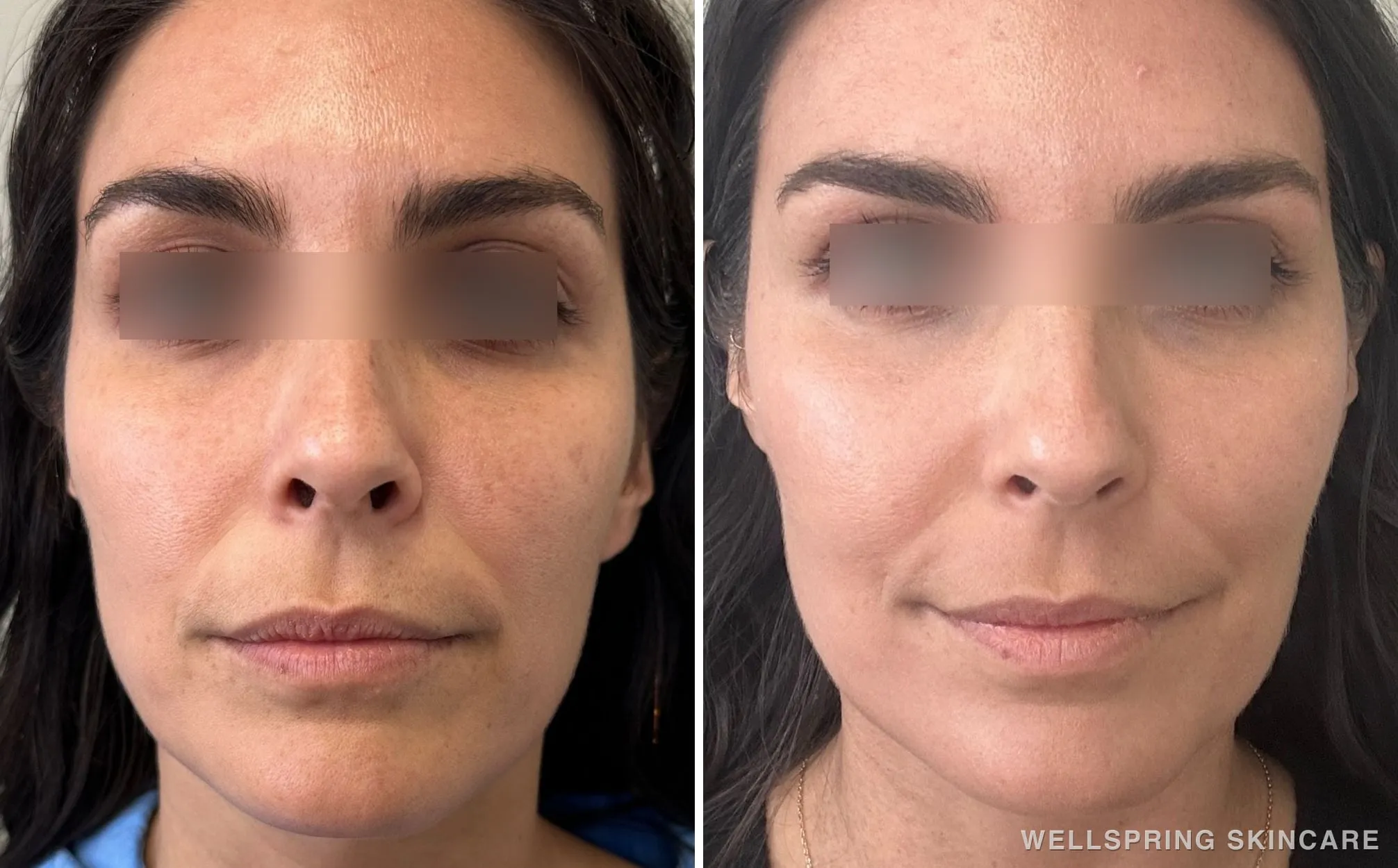 Before and after: Sun damage & brown spots treated with Halo