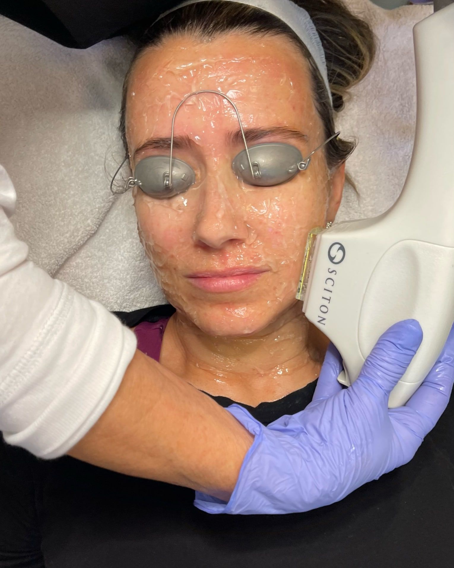 IPL photofacial treatment at Wellspring Skincare in Roswell