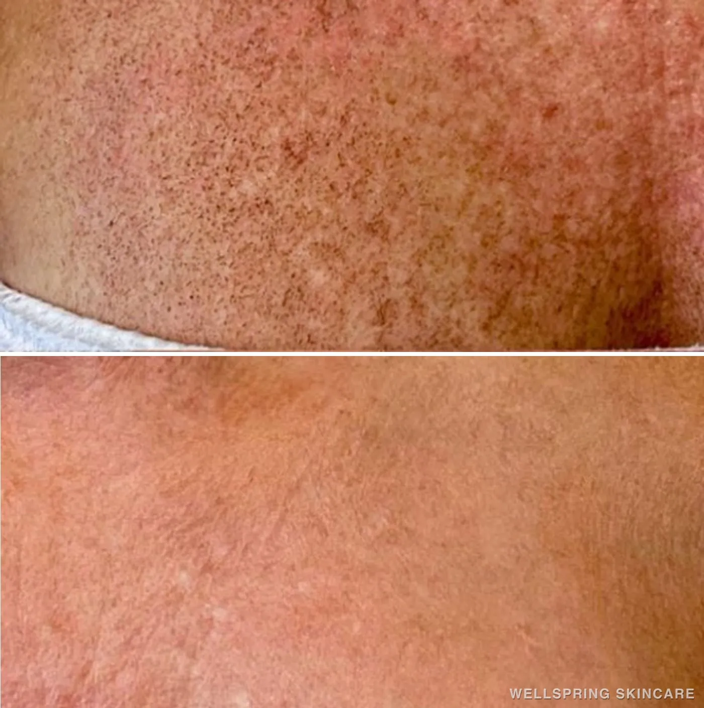 Before and after: Sun damage & brown spots treated with IPL