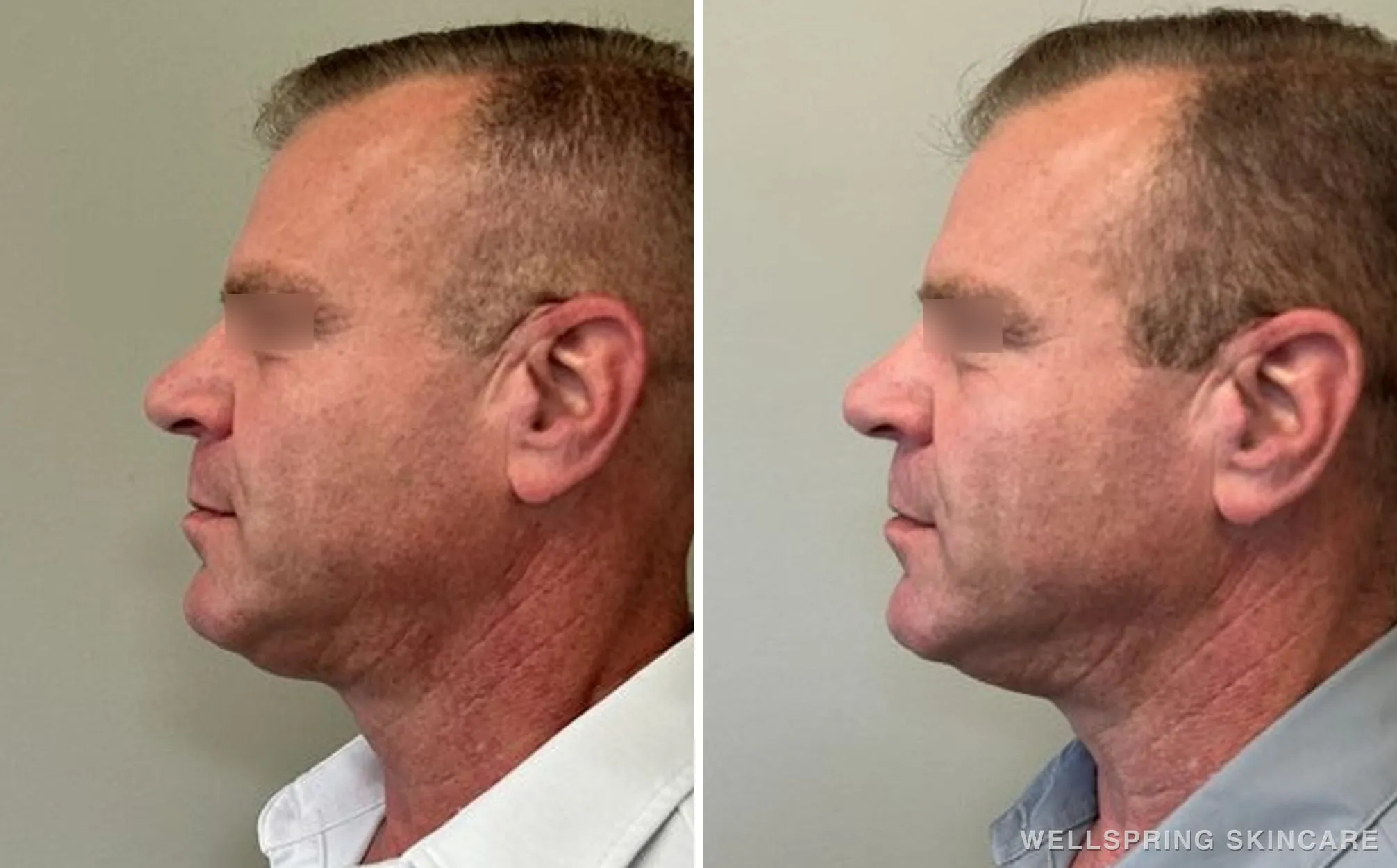Before and after: Double chin treated with Kybella