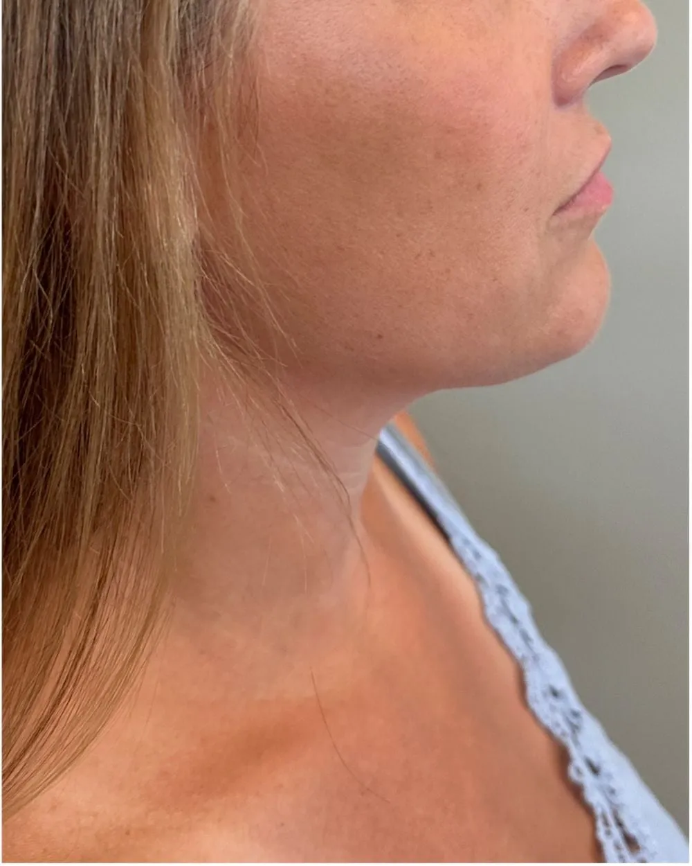 After: Double chin treated with Kybella