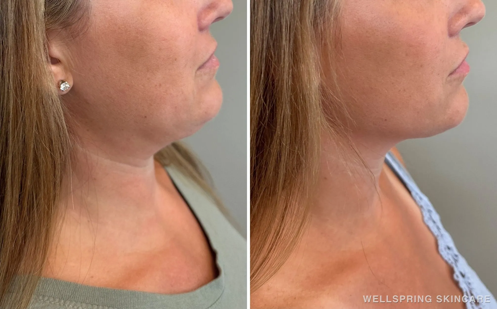 Before and after: Double chin treated with Kybella