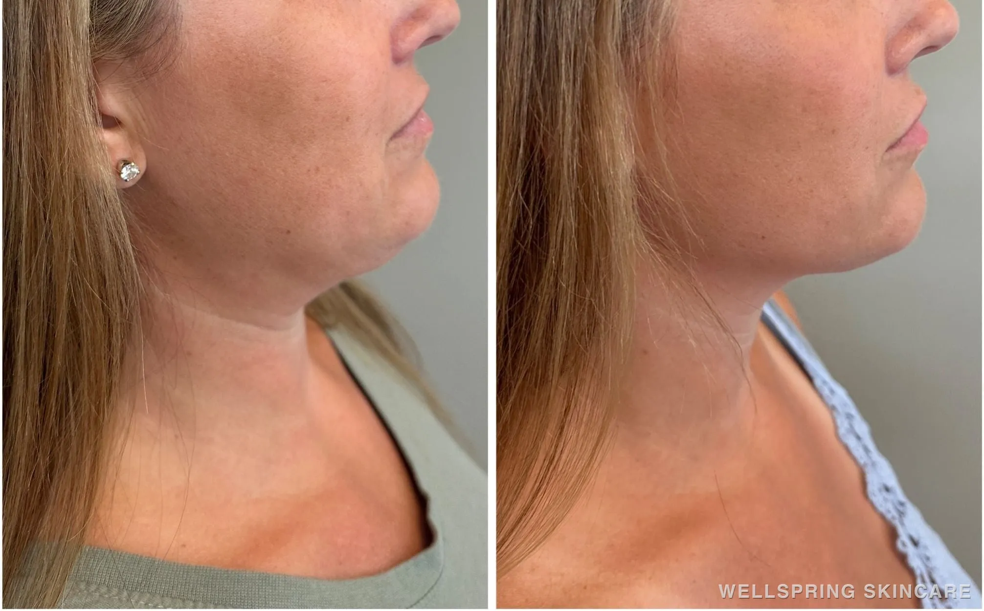 Before and after: Double chin treated with Kybella