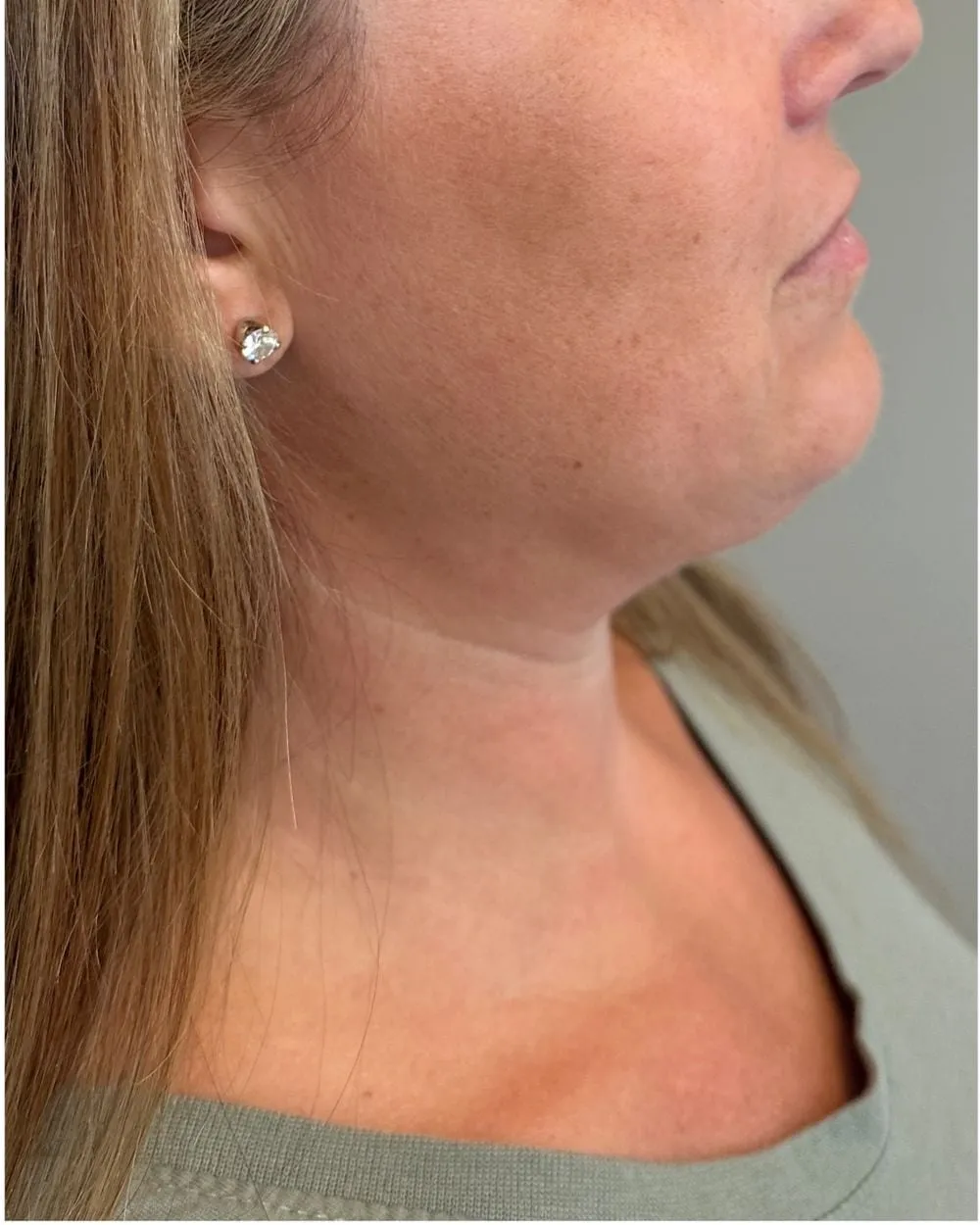 Before: Double chin treated with Kybella