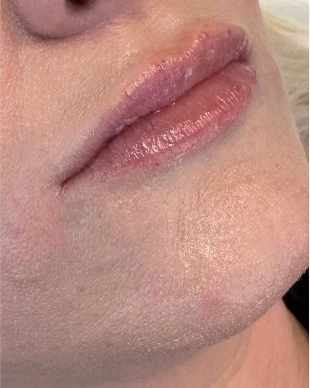 After: After Lip filler