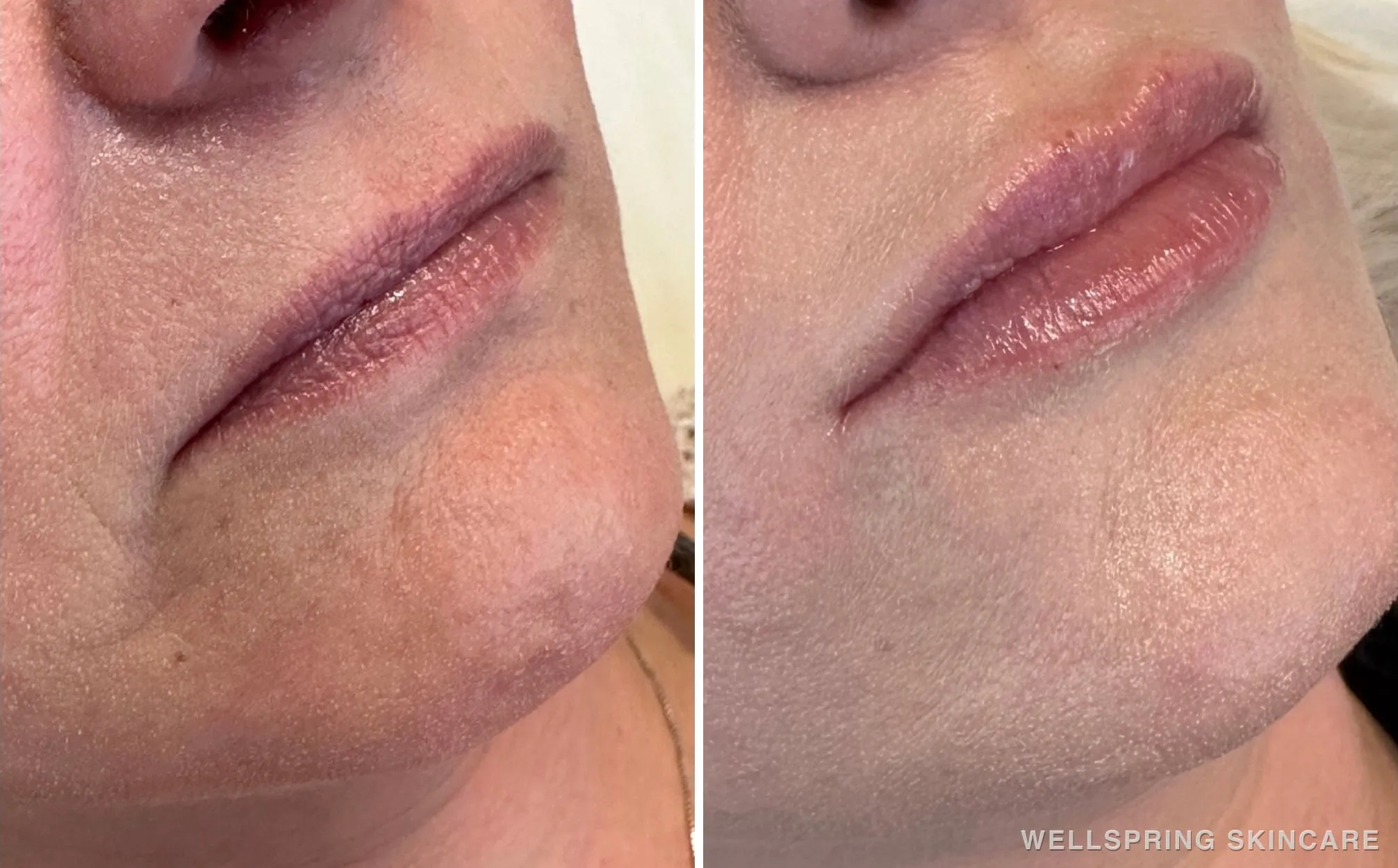 Before and after: Lips treated with lip filler
