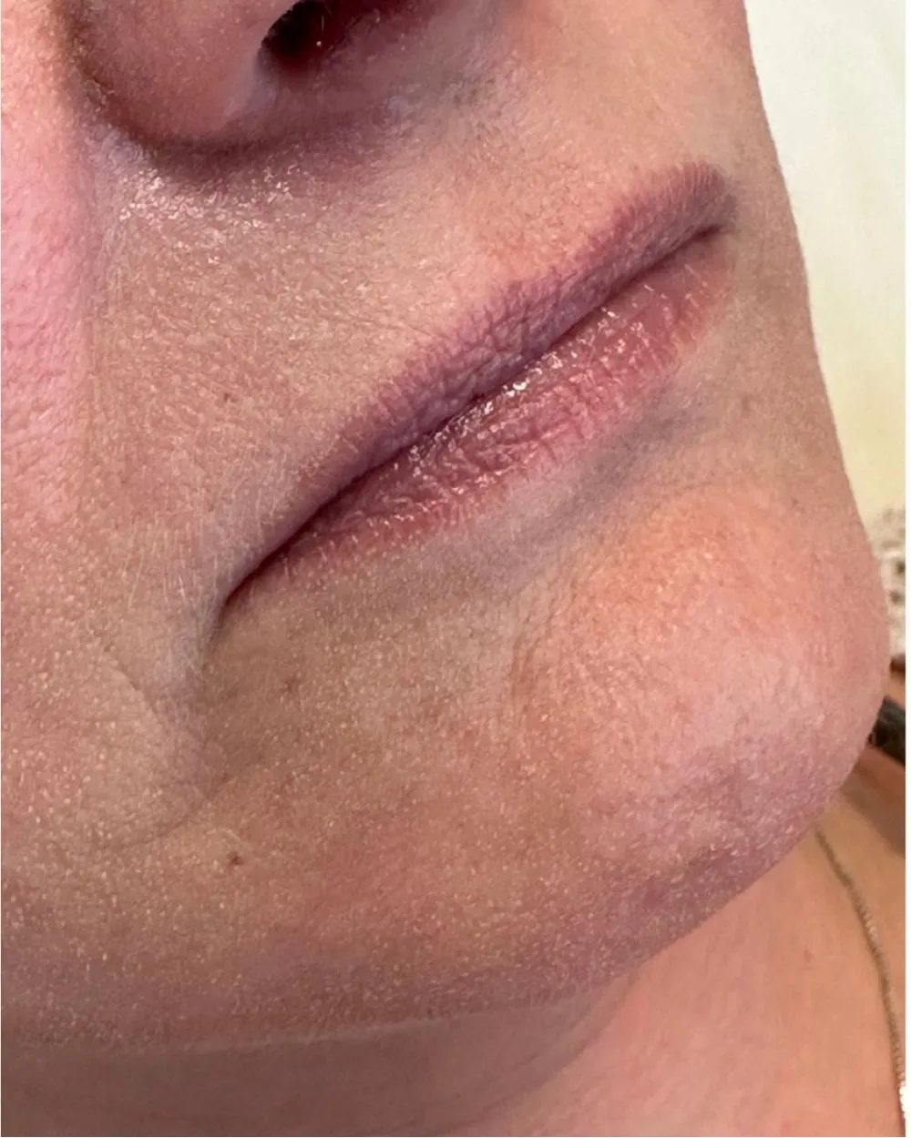 Before: After Lip filler