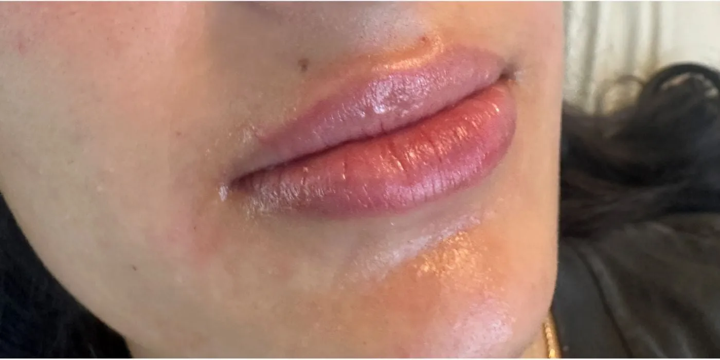 After: After Lip filler