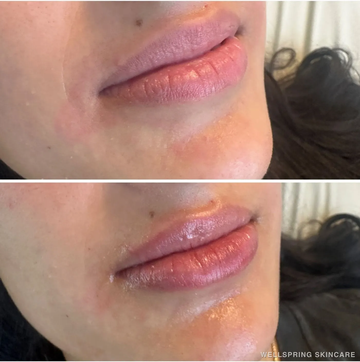 Before and after: Fuller lips with lip filler