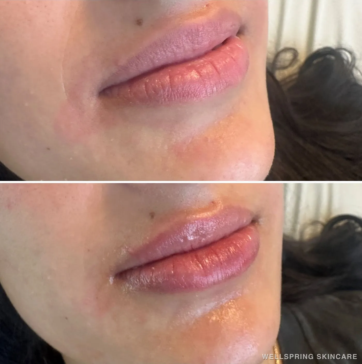 Before and after: Fuller lips with lip filler