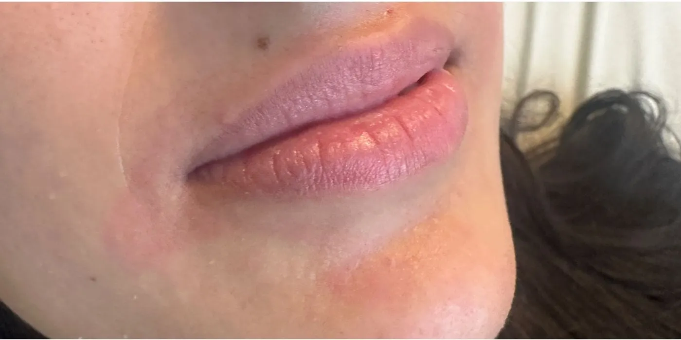 Before: After Lip filler