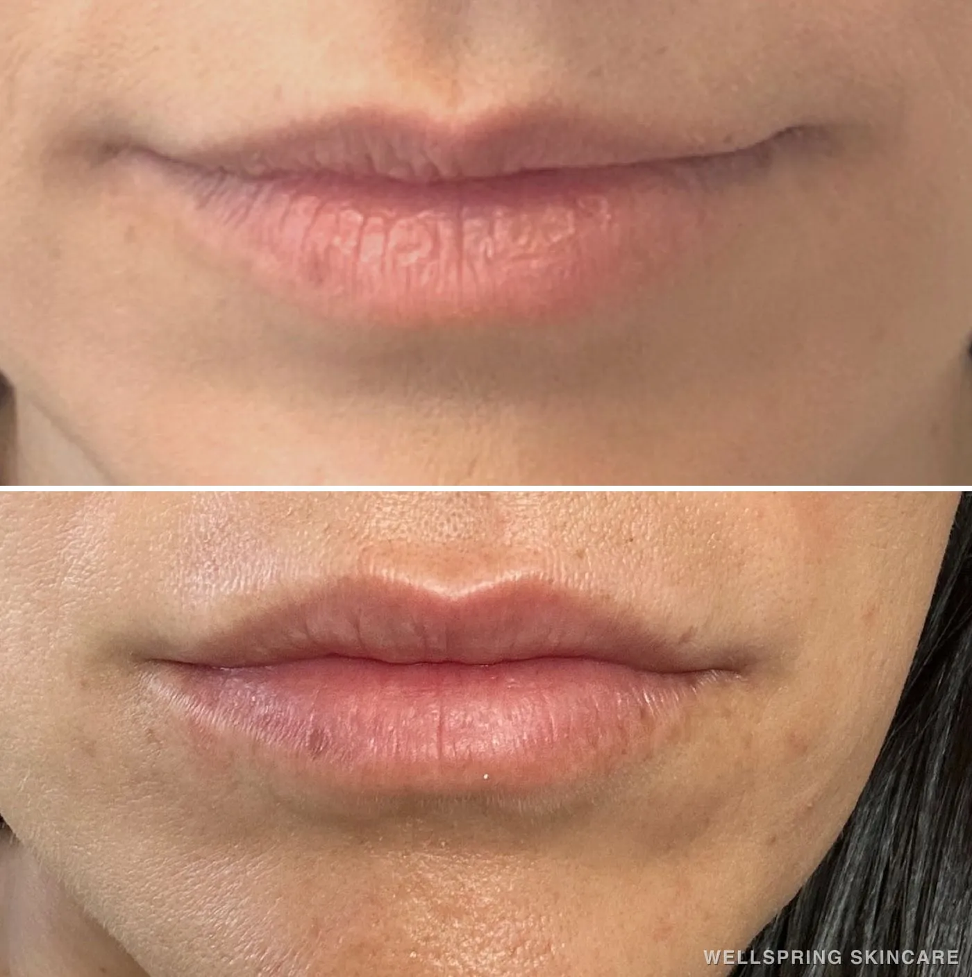 Before and after: Lip shape & volume with lip filler