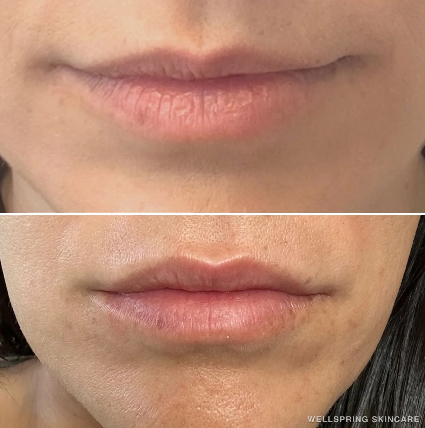 Before and after: Lip shape & volume with lip filler