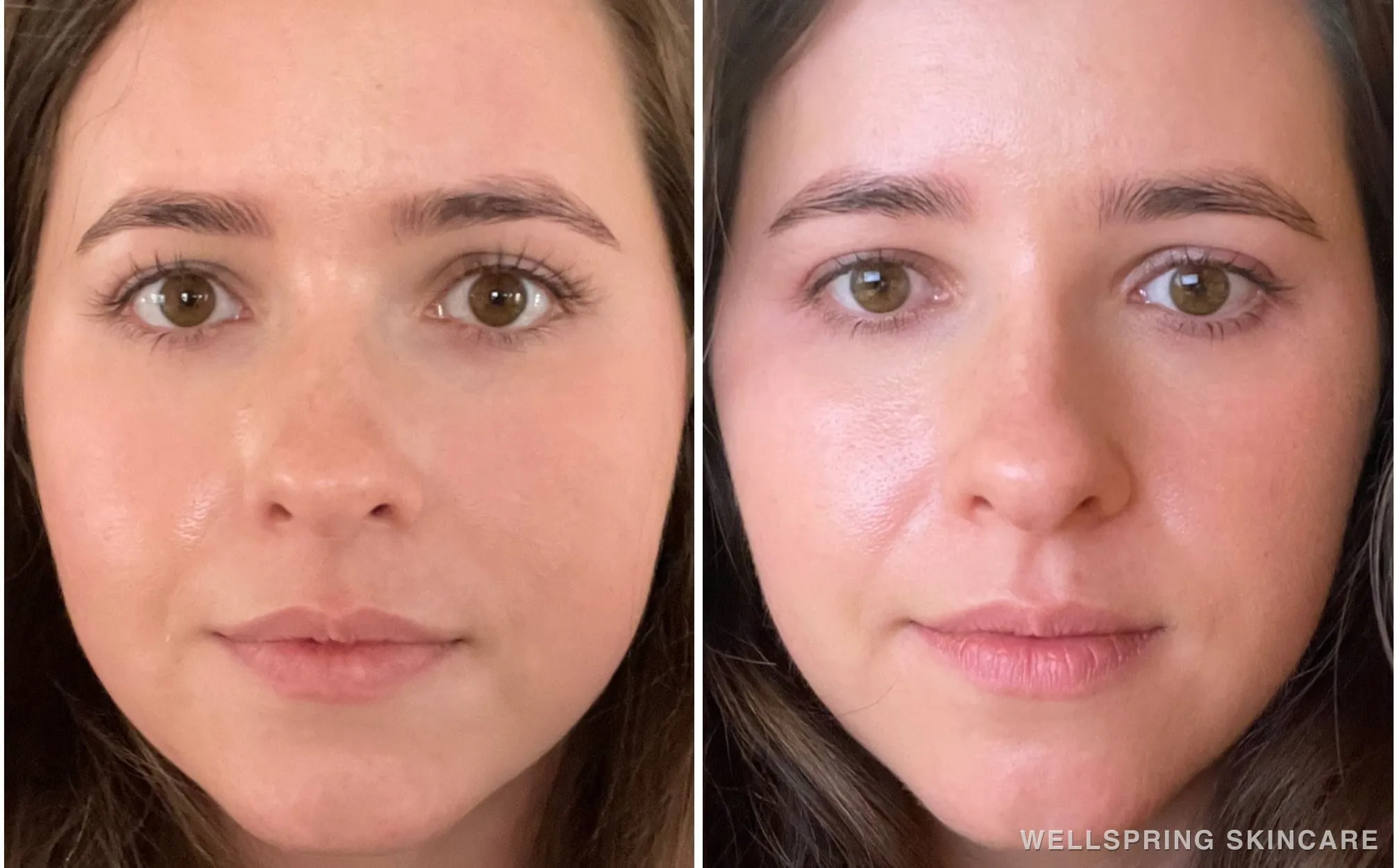 Before and after: Jaw slimming with masseter Botox