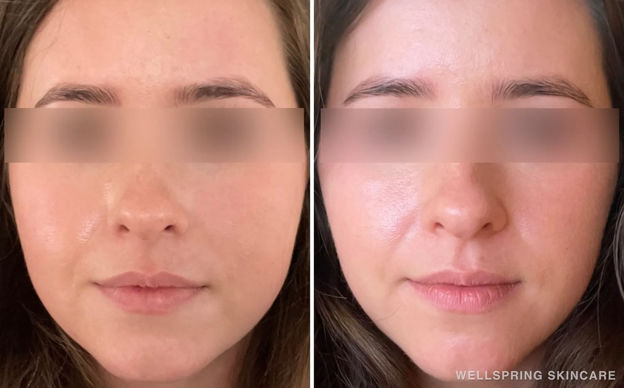 Before and after: Jaw slimming with masseter Botox