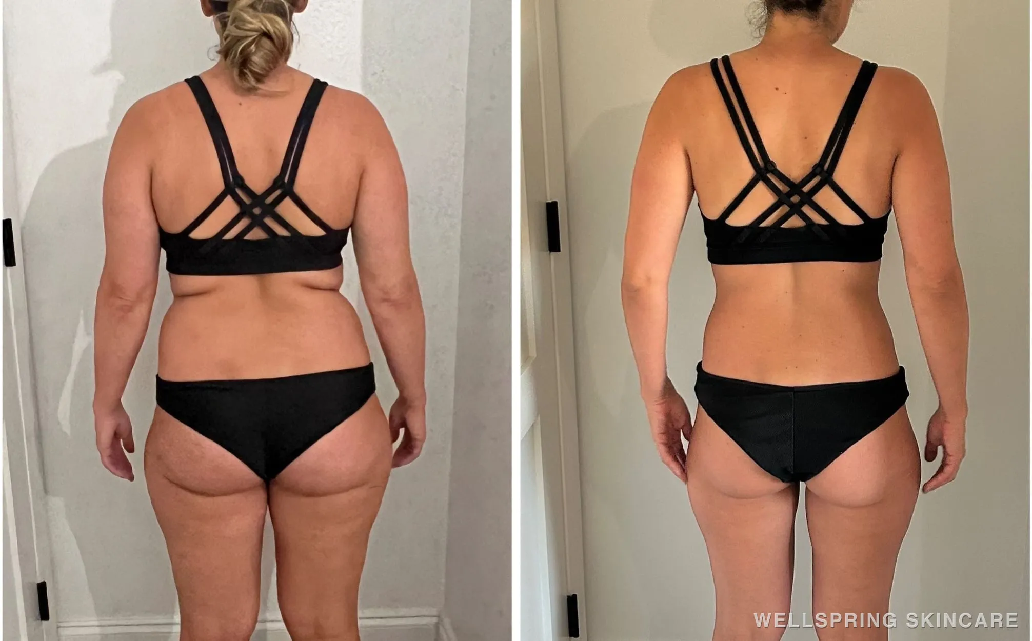 Before and after: Physician-supervised medical weight loss