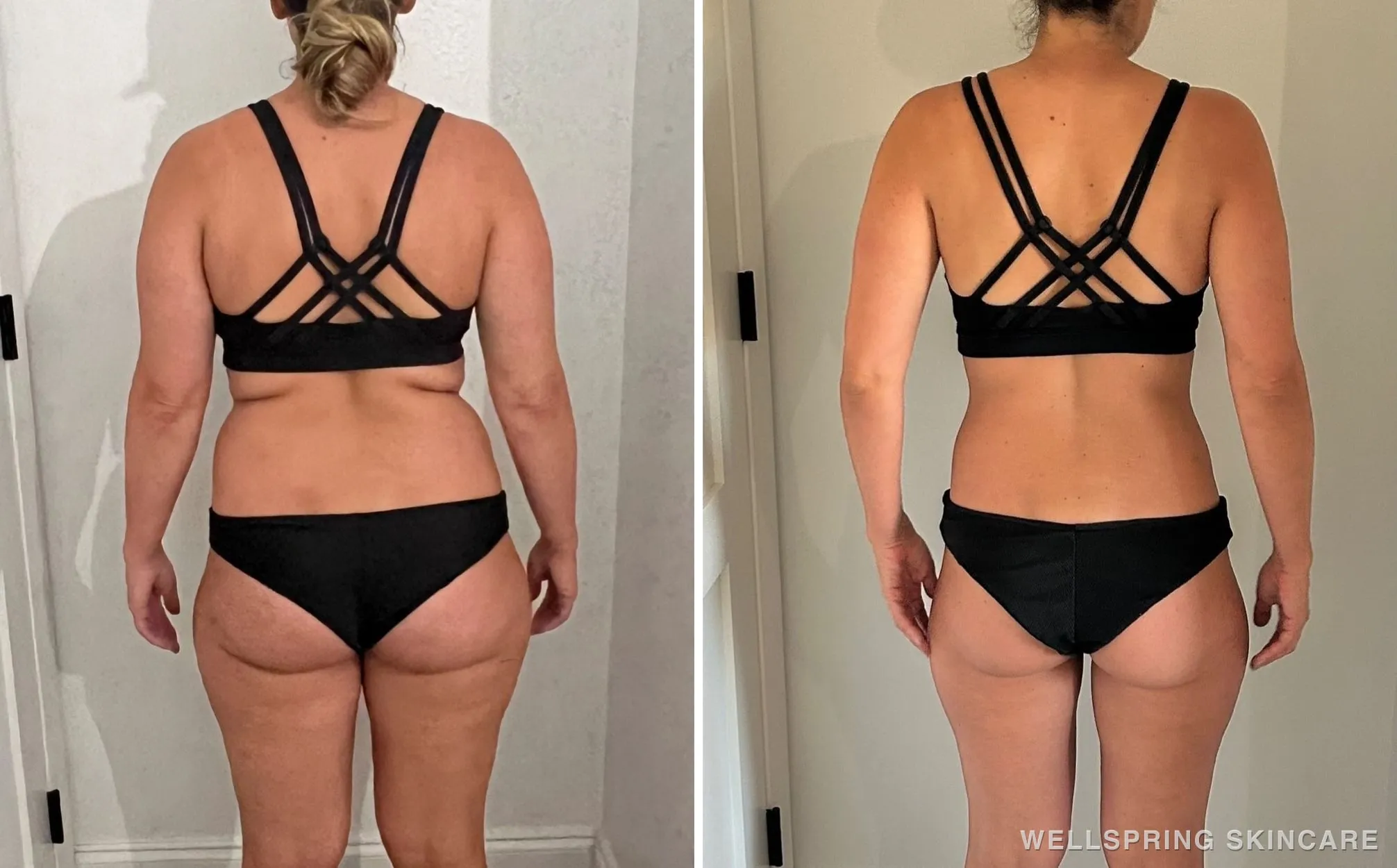 Before and after: Physician-supervised medical weight loss