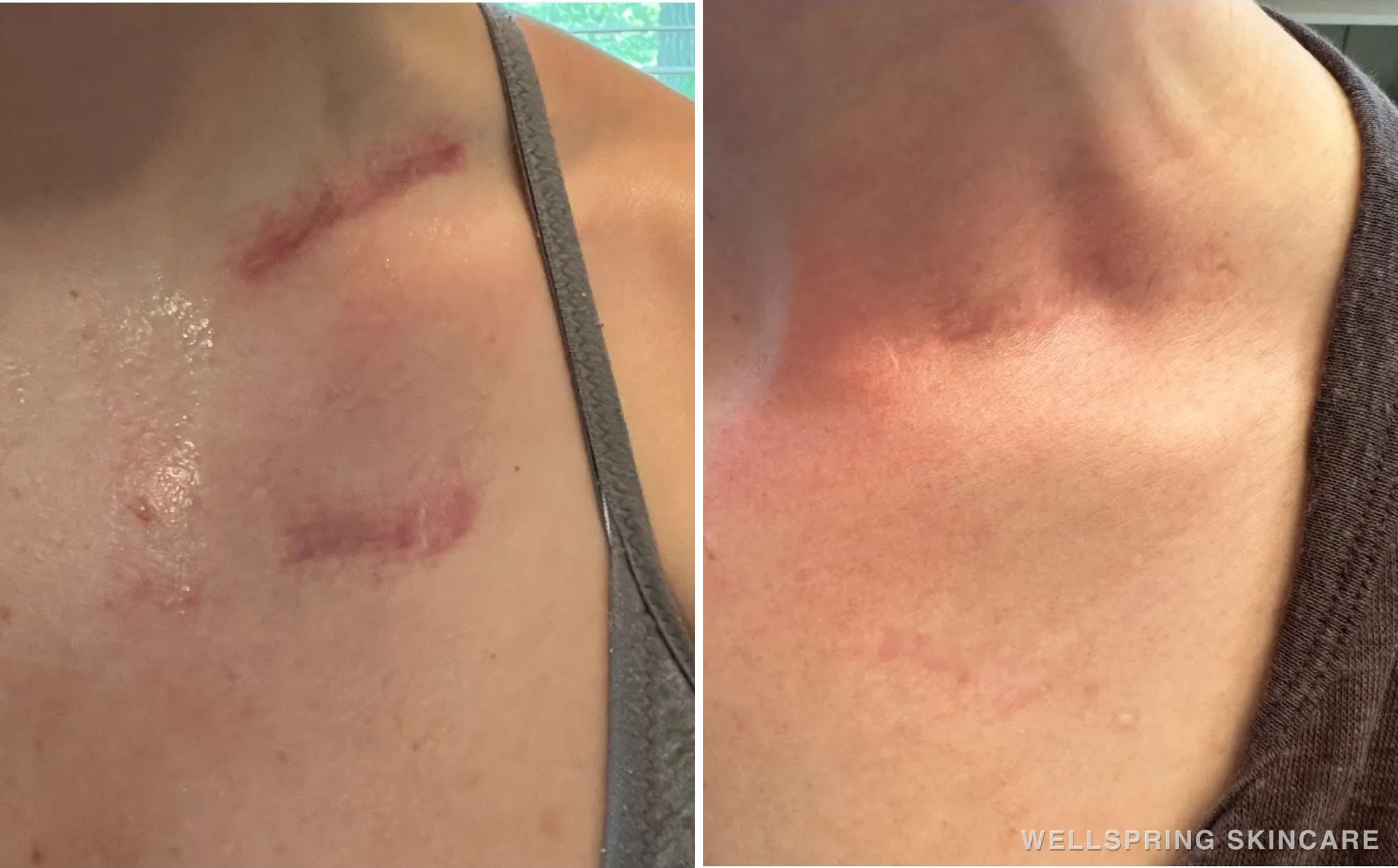 Before and after: Acne scars & texture treated with microneedling & BBL