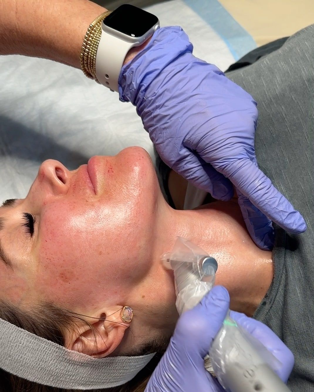 Microneedling treatment at Wellspring Skincare in Roswell
