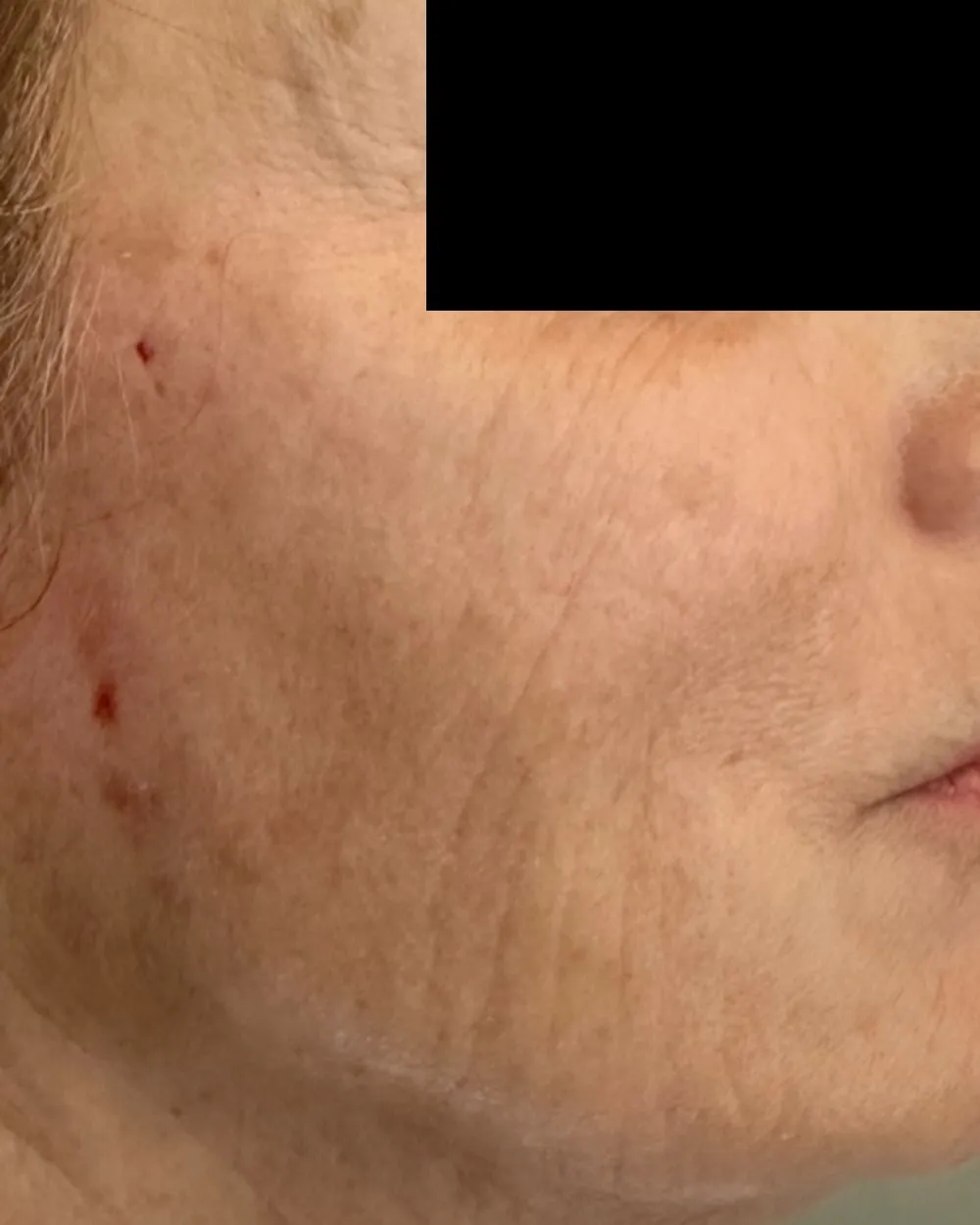 After: Jowls & sagging skin treated with a PDO thread lift