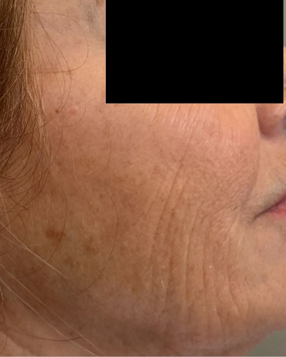 Before: Jowls & sagging skin treated with a PDO thread lift