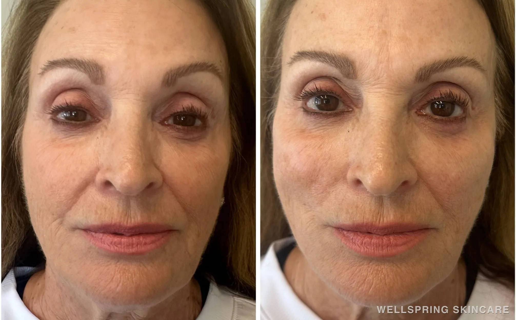 Before and after: Jowls & sagging skin treated with a PDO thread lift