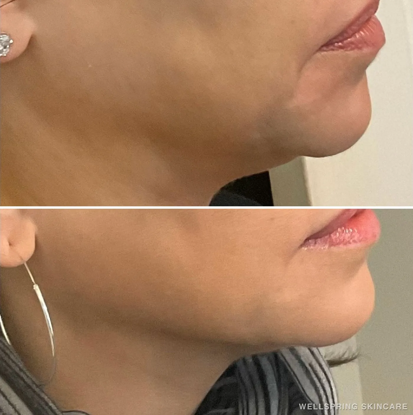 Before and after: Jawline & neck treated with a PDO thread lift