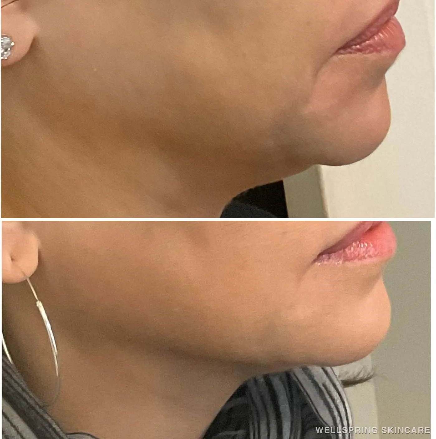 Before and after: Jawline & neck treated with a PDO thread lift