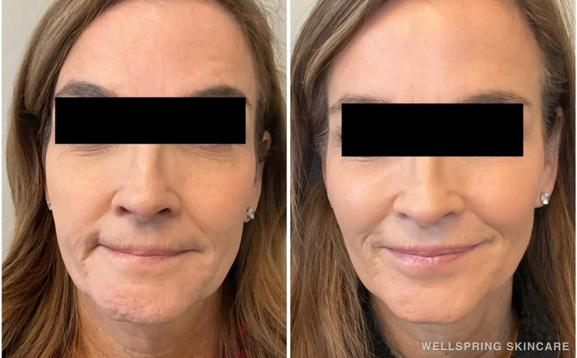 Before and after: Jowls & sagging skin treated with a PDO thread lift
