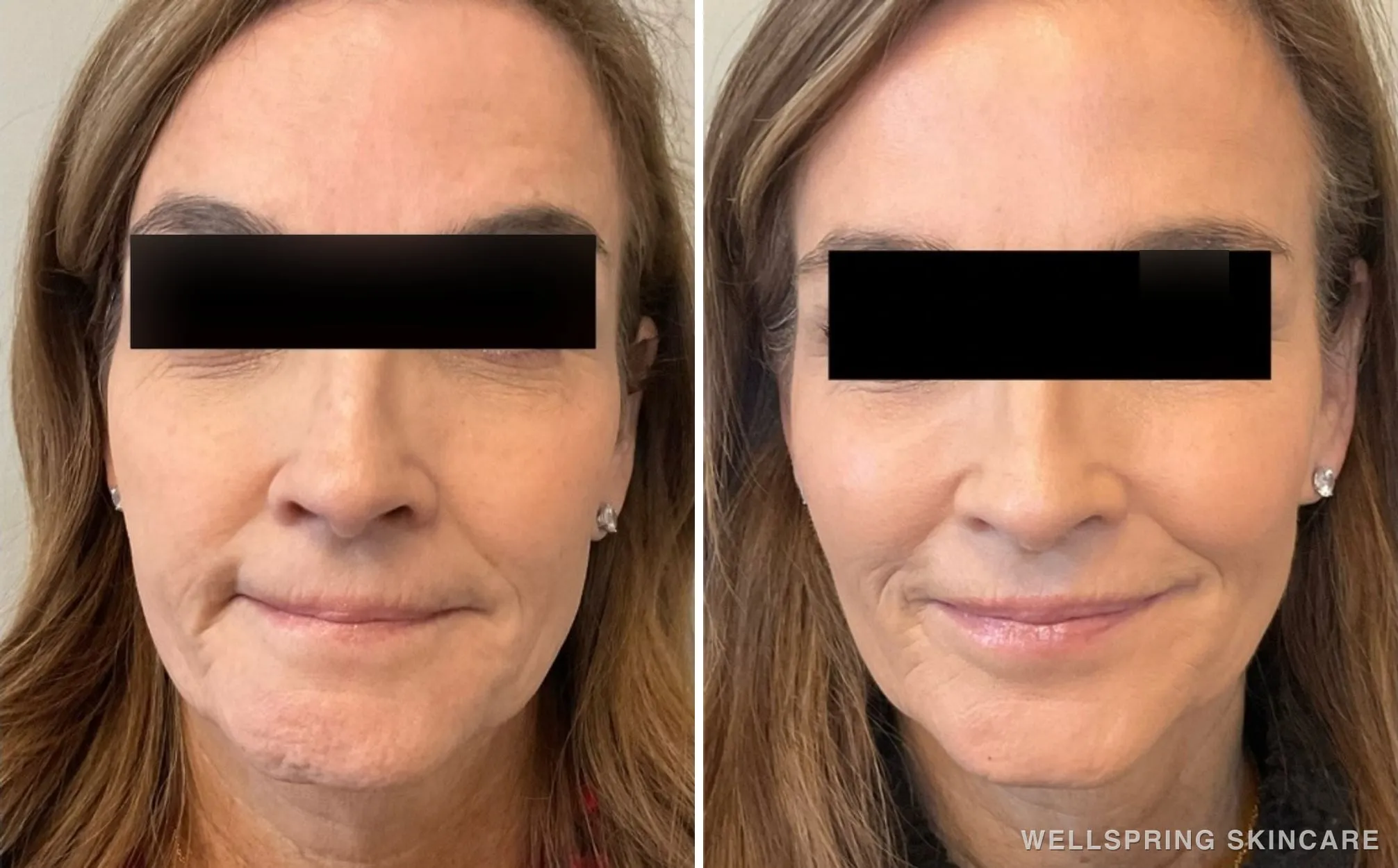 Before and after: Jowls & sagging skin treated with a PDO thread lift