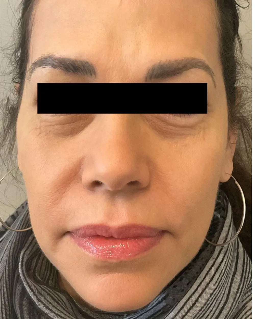 After: Jowls & sagging skin treated with a PDO thread lift