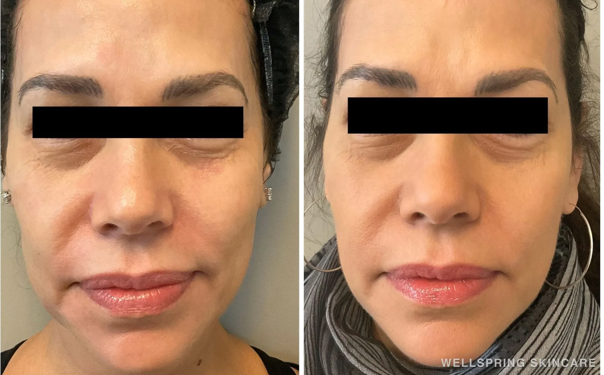 Before and after: Jowls & sagging skin treated with a PDO thread lift