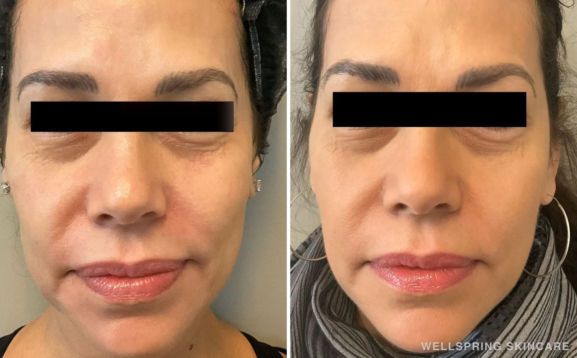 Before and after: Jowls & sagging skin treated with a PDO thread lift