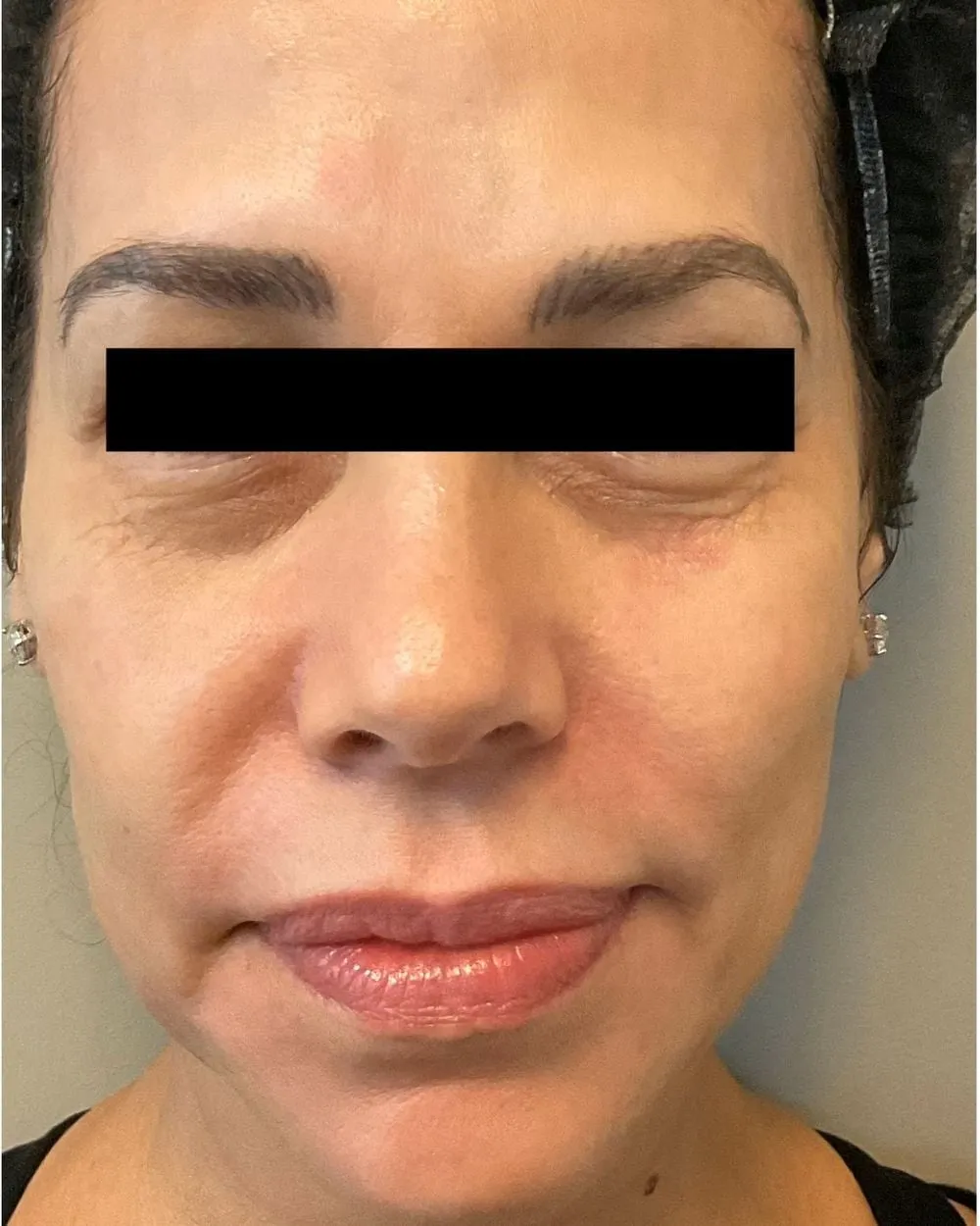 Before: Jowls & sagging skin treated with a PDO thread lift