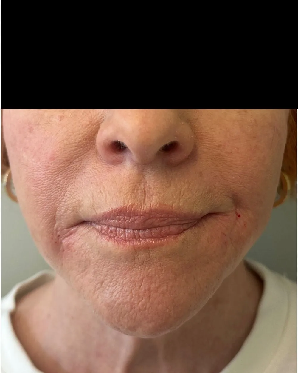 After: Marionette & smile lines treated with a PDO thread lift
