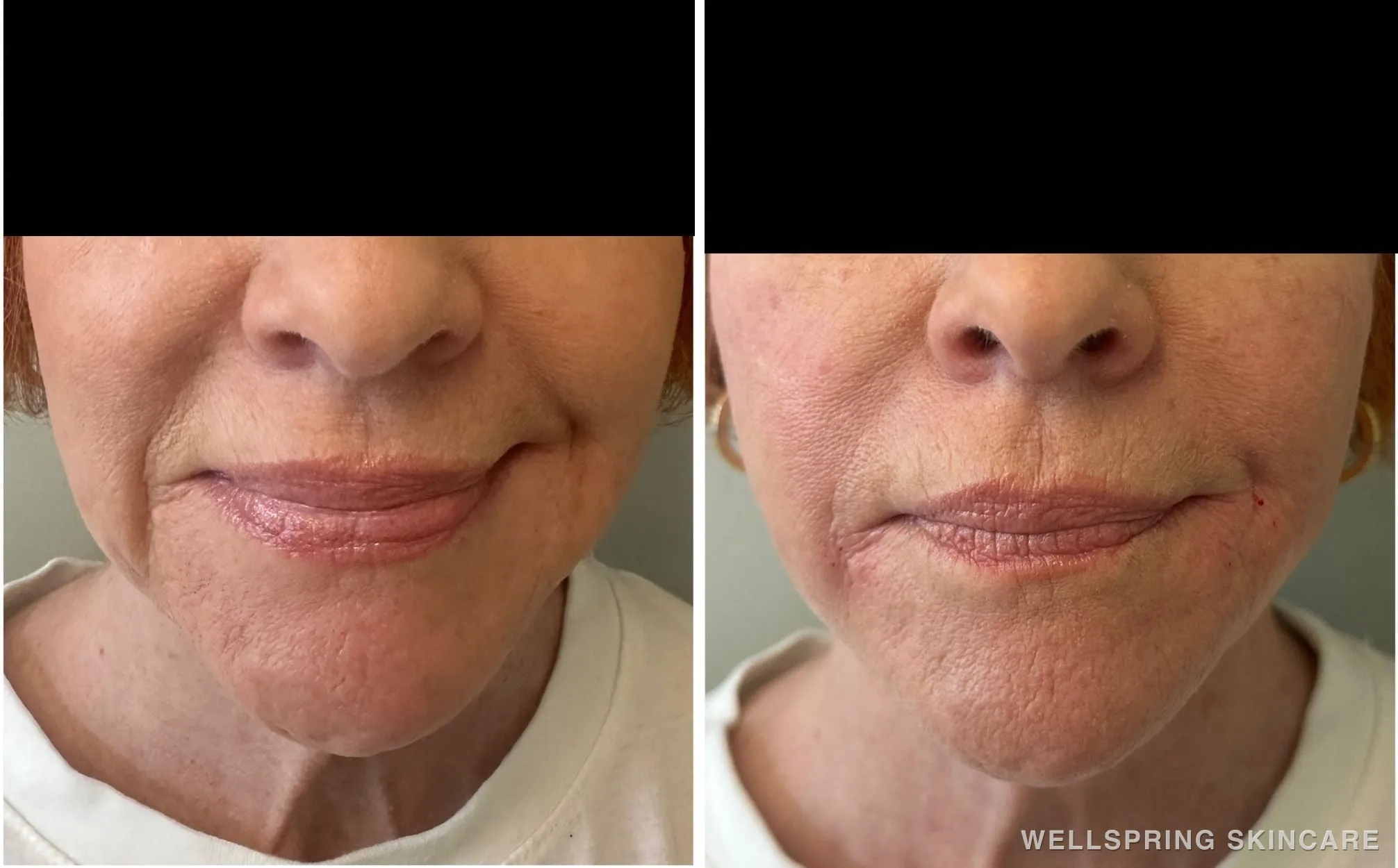 Before and after: Marionette & smile lines treated with a PDO thread lift