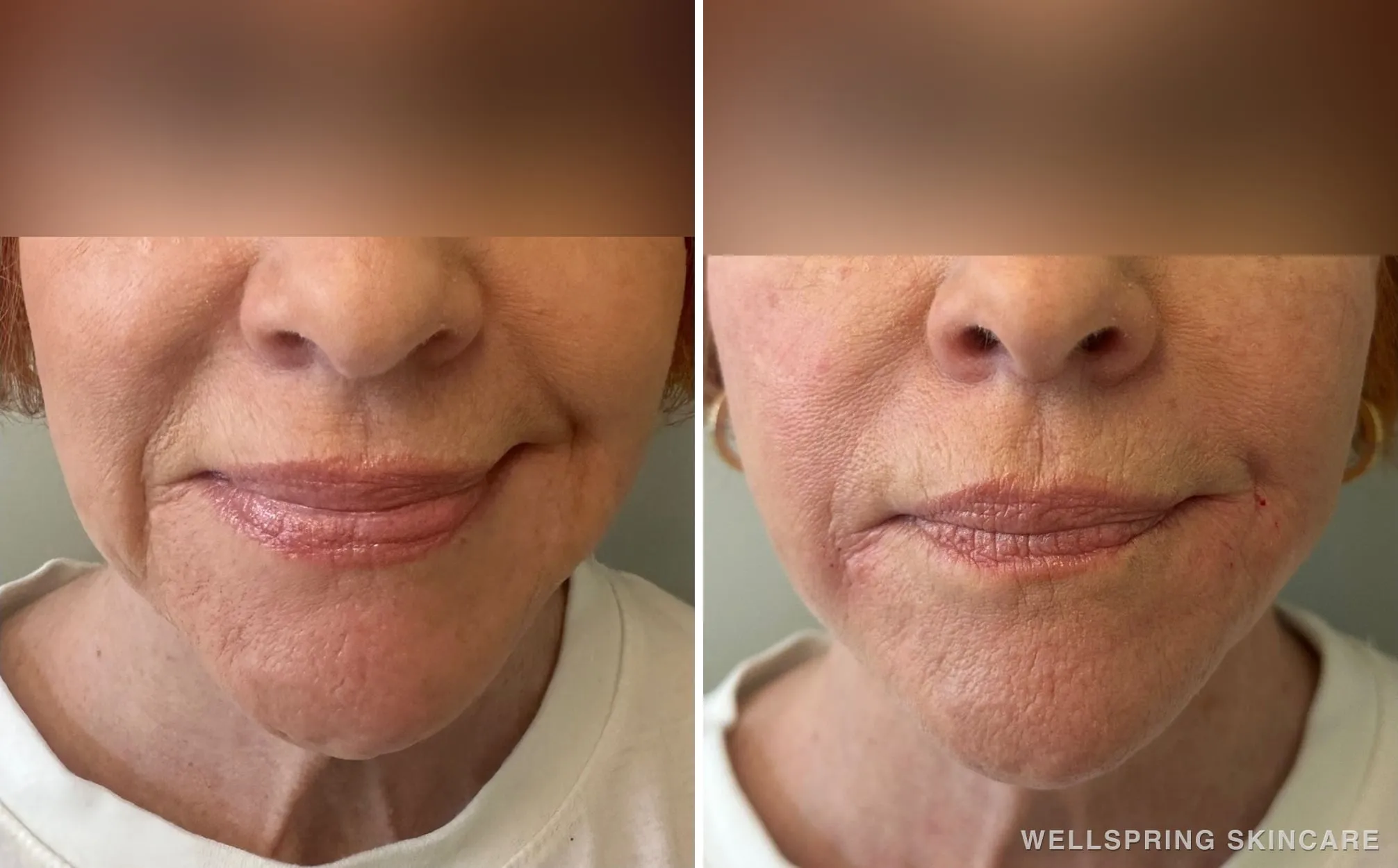 Before and after: Marionette & smile lines treated with a PDO thread lift