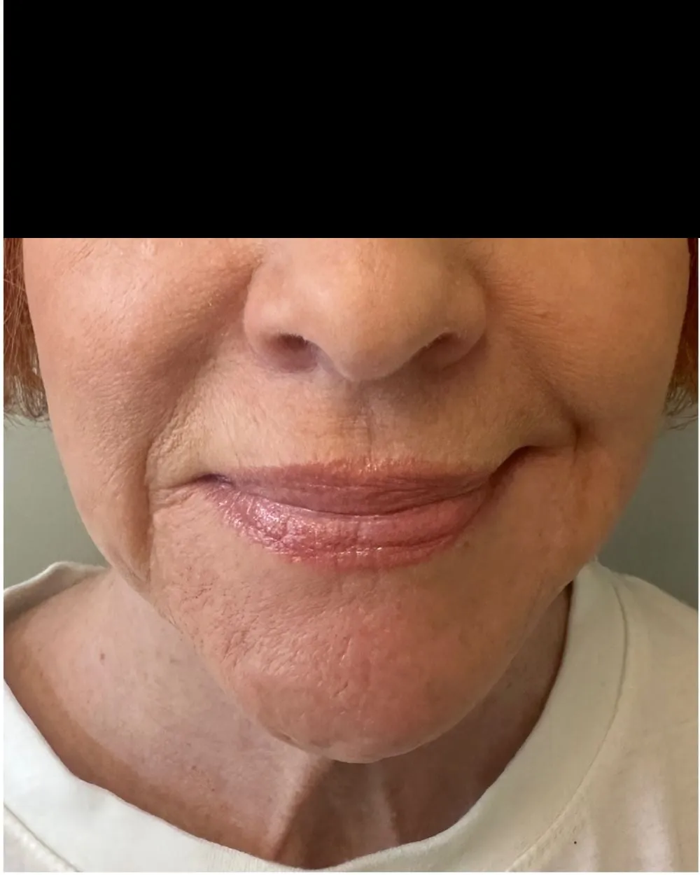 Before: Marionette & smile lines treated with a PDO thread lift