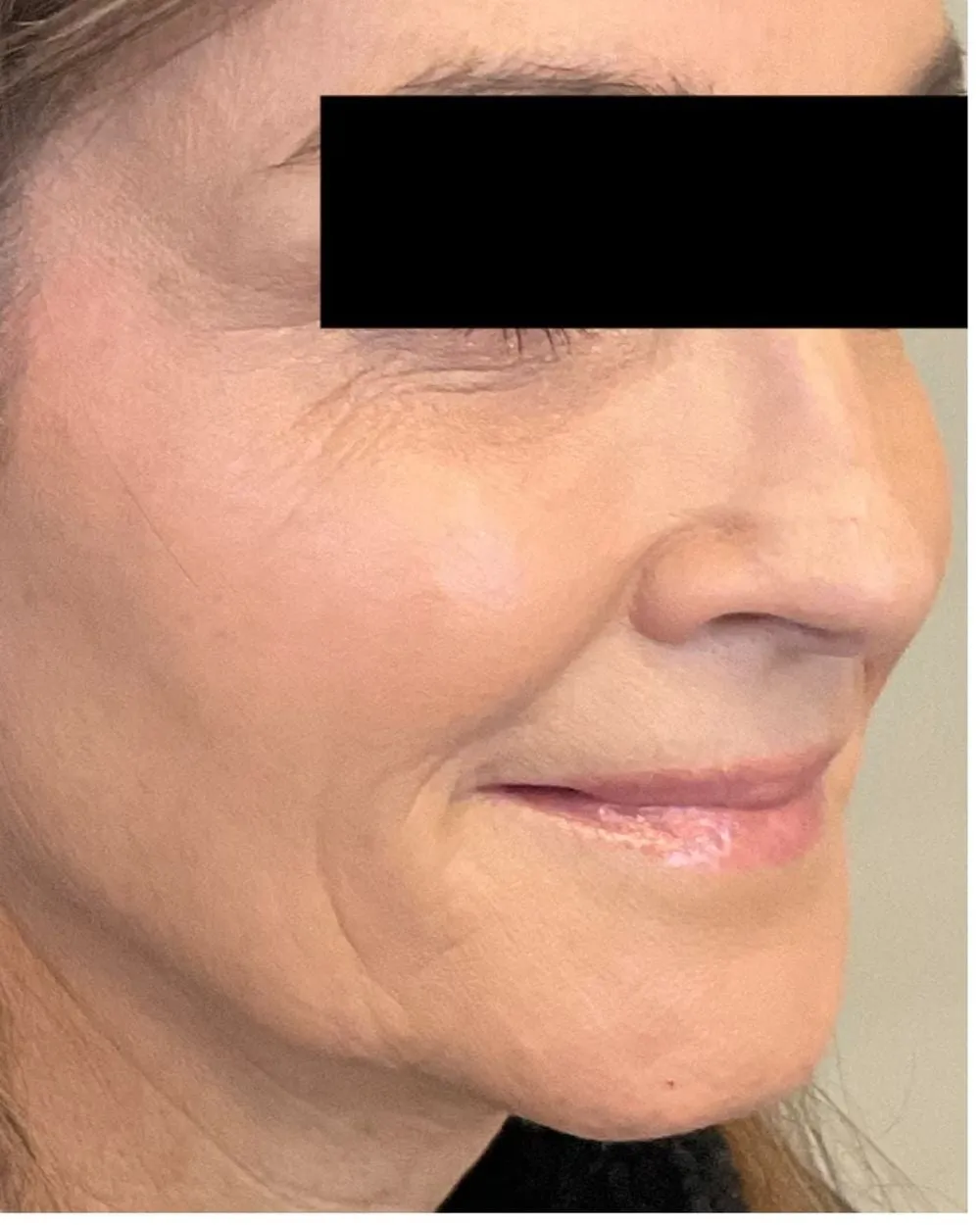 After: Marionette & smile lines treated with a PDO thread lift