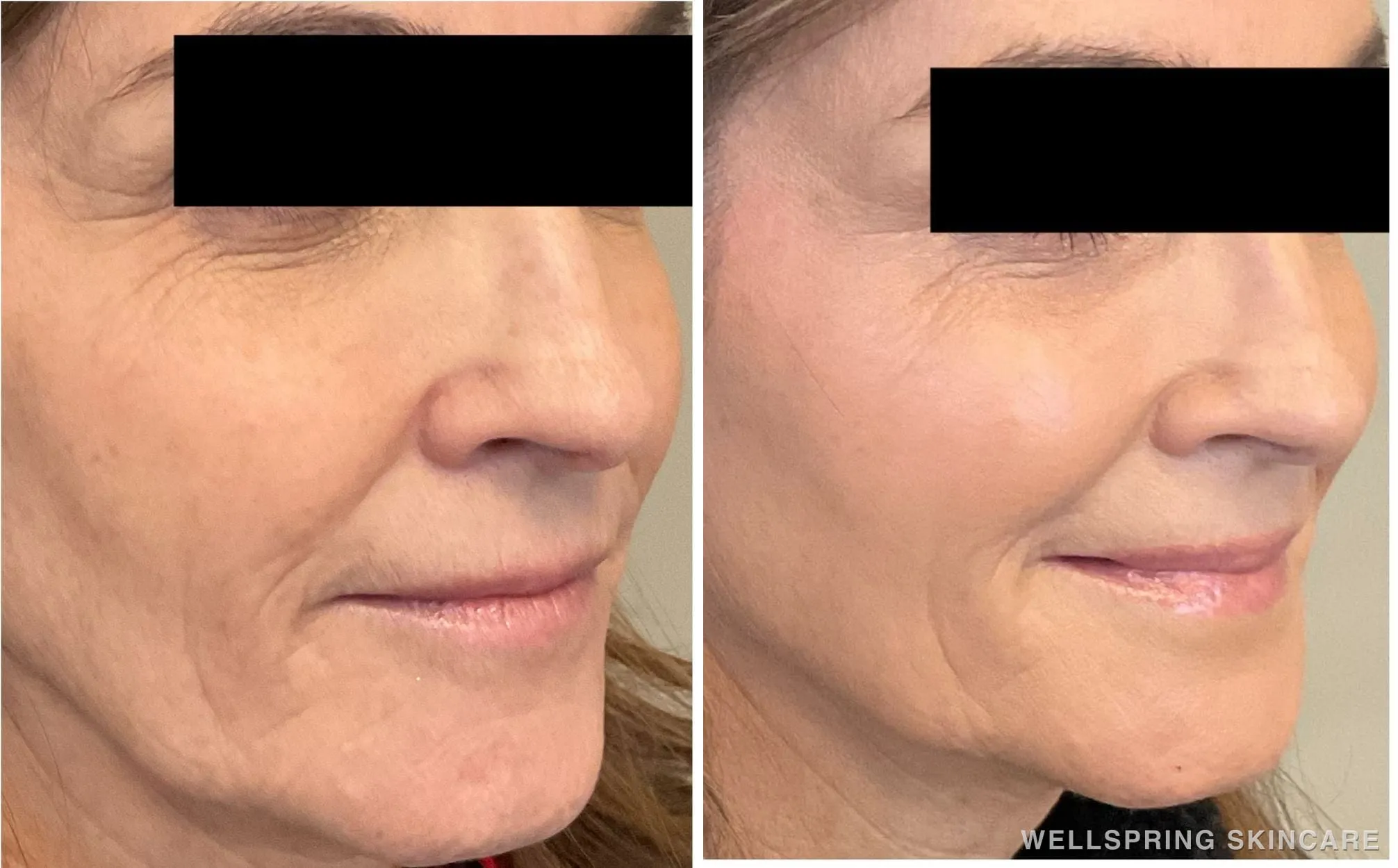 Before and after: Marionette & smile lines treated with a PDO thread lift