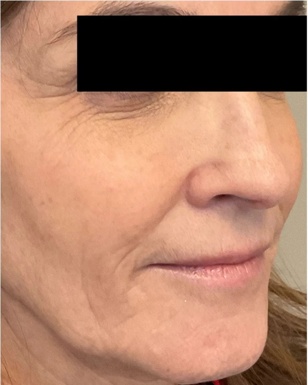 Before: Marionette & smile lines treated with a PDO thread lift