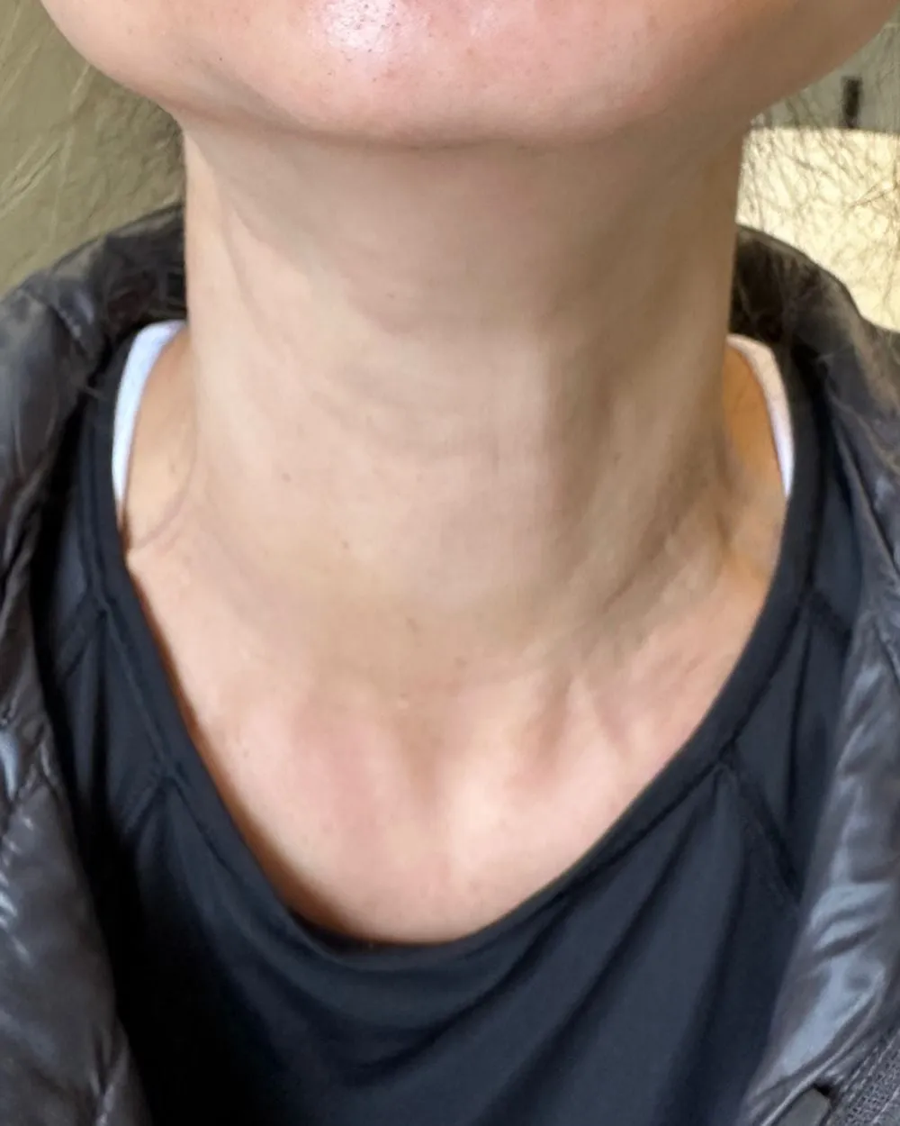 After: After platysmal band neck Botox