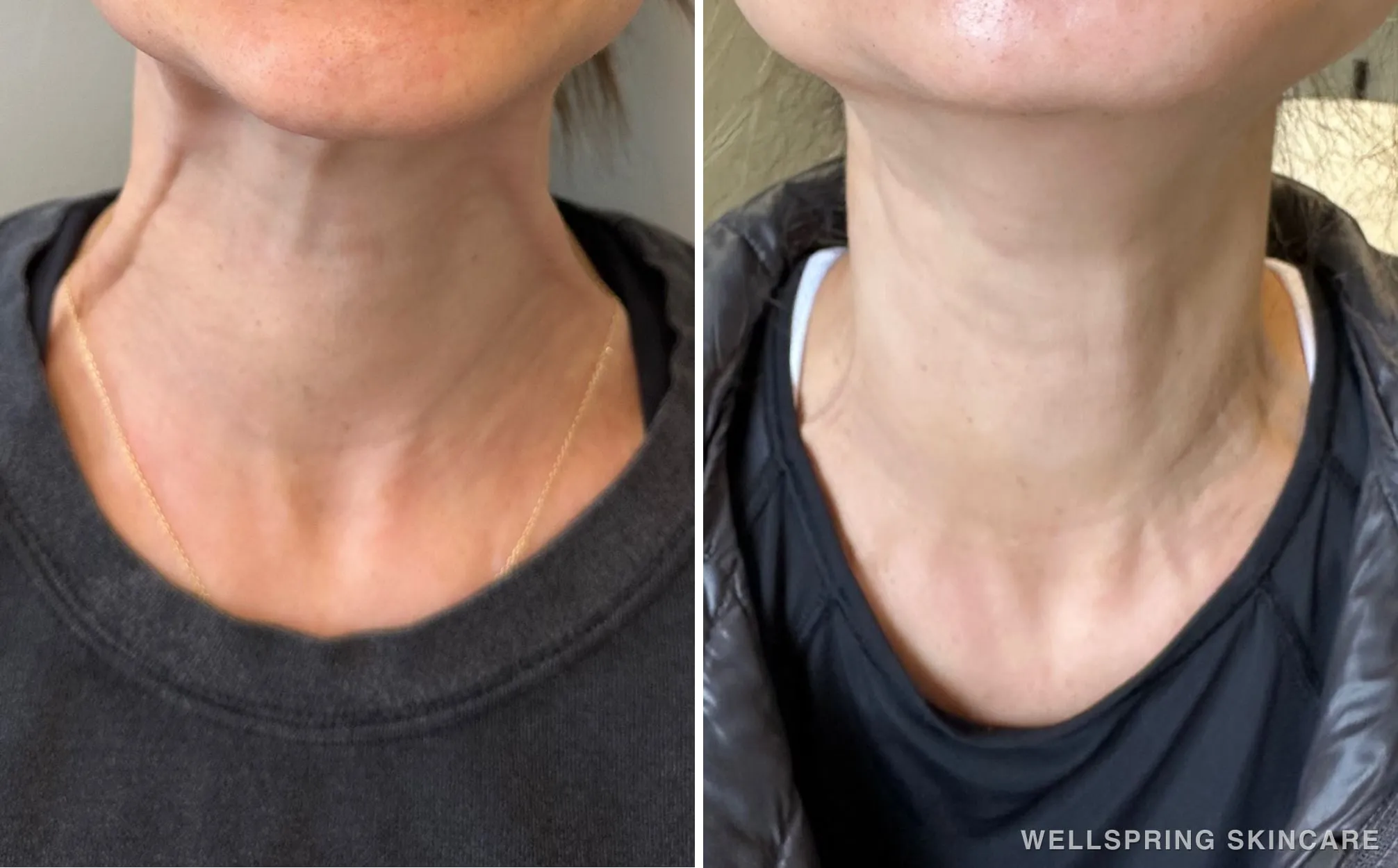 Before and after: Platysmal neck bands treated with Botox