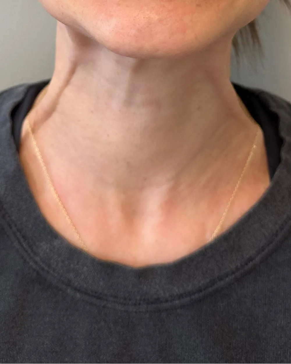 Before: After platysmal band neck Botox
