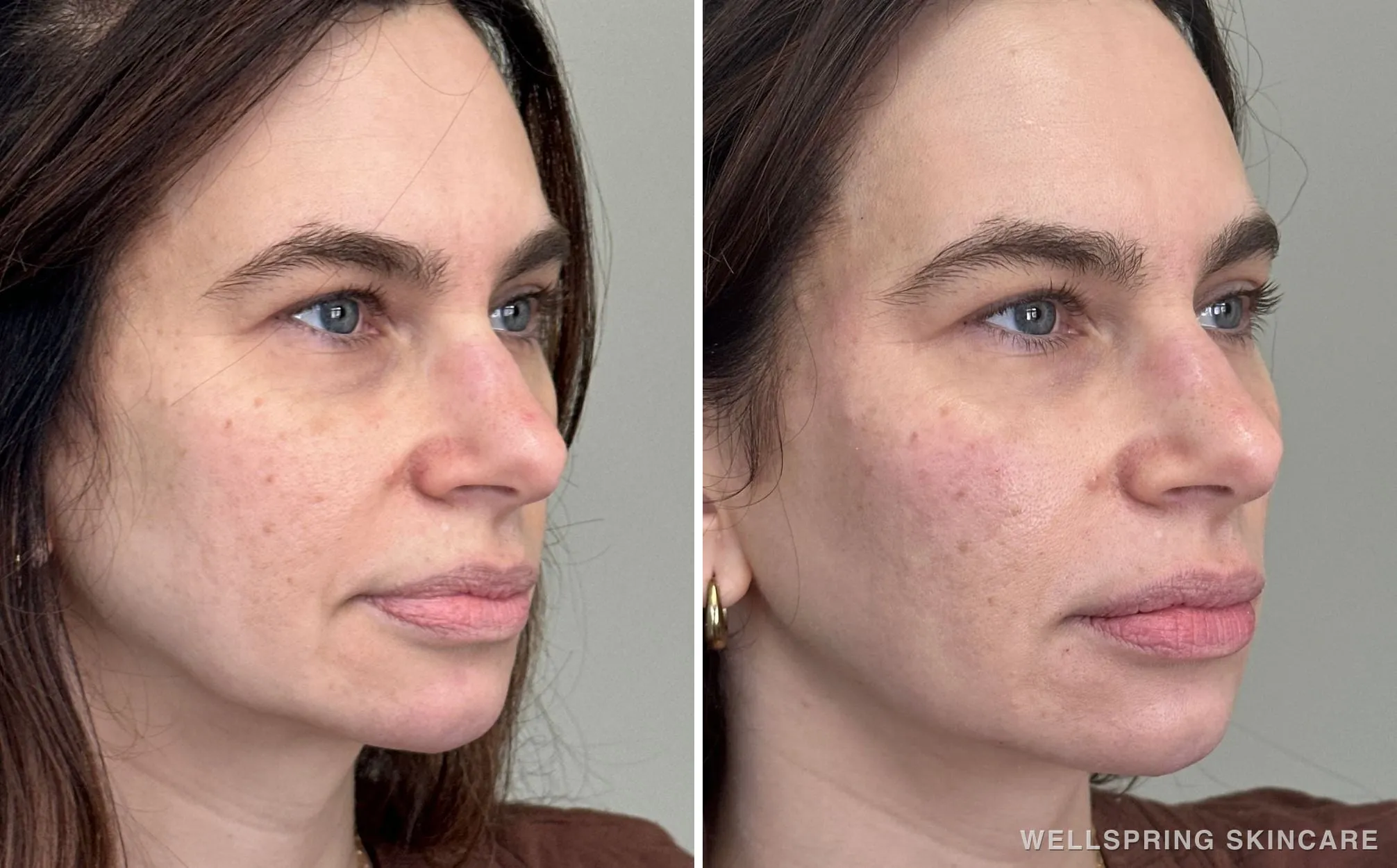 Before and after: Under-eye hollows treated with PRF