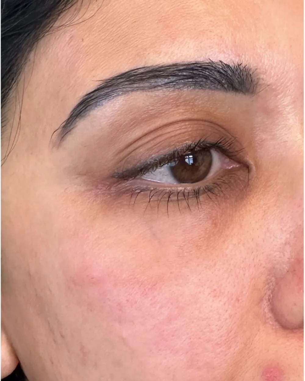 After: Dark eye bags treated with PRF