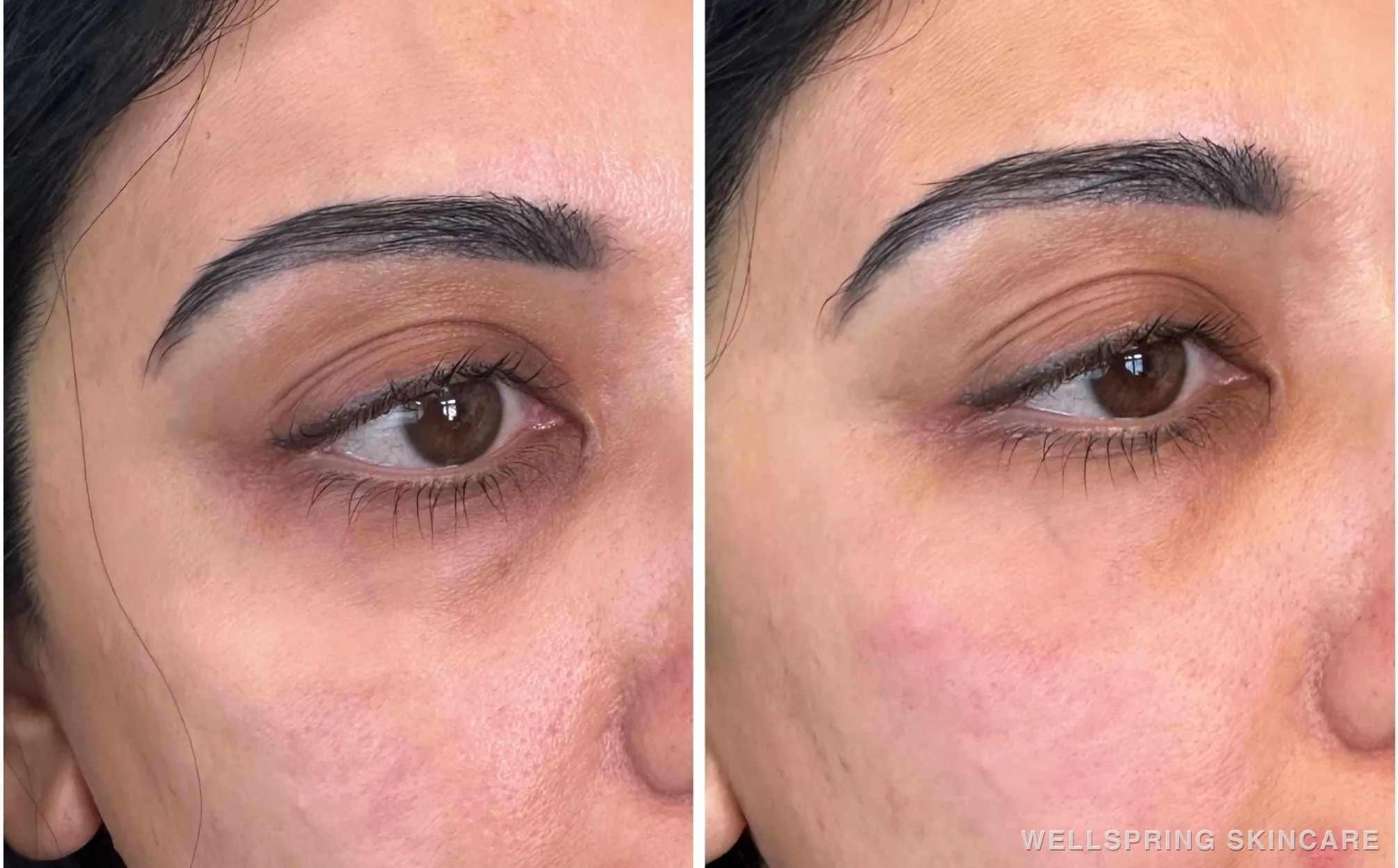 Before and after: Dark eye bags treated with PRF