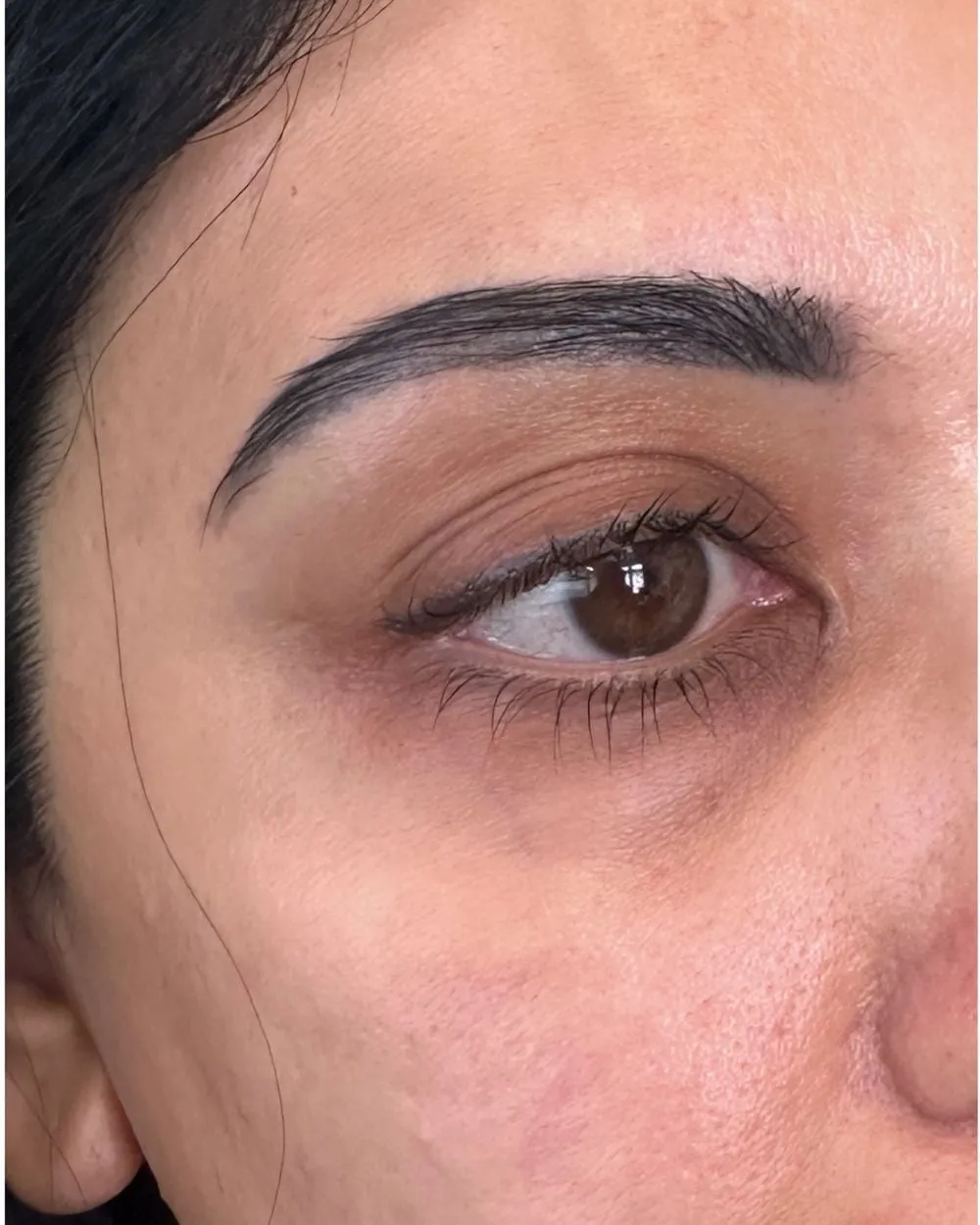 Before: Dark eye bags treated with PRF