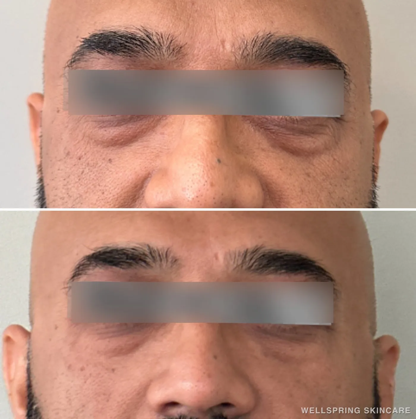 Before and after: Tired under-eyes treated with PRF